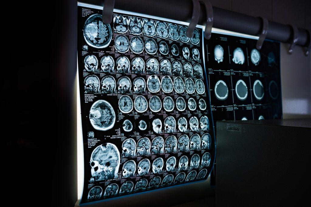 Neurologische Untersuchung mit MRT Bildern